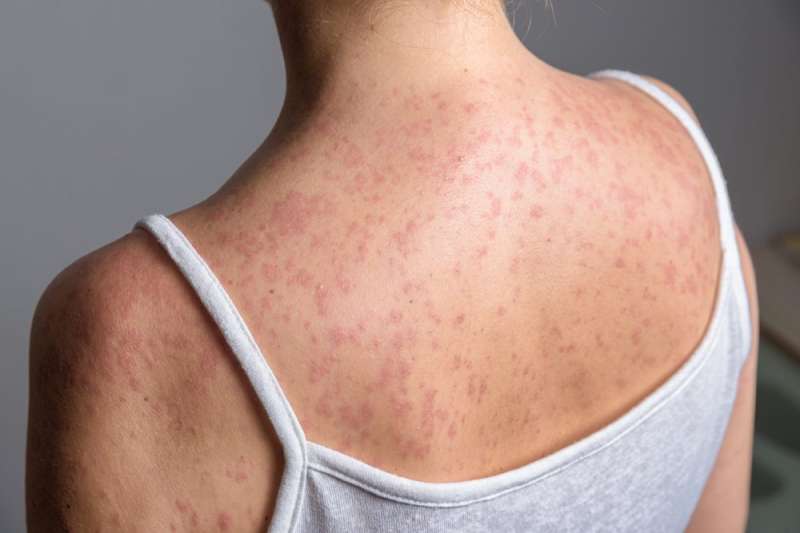 Opinion: NC pediatrician on measles outbreak